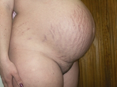 Striae  distensae nebli pajizévky