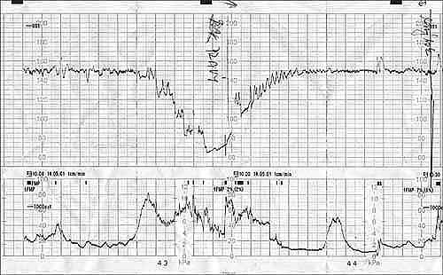 aortokavální kompresivní syndrom - ctg záznam
