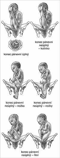 konec pánevní - držení plodu