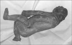 anencefalus
