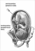Amniocentéza a kordocentéza
