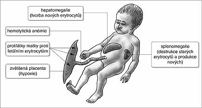 Erytrocytová aloimunizace