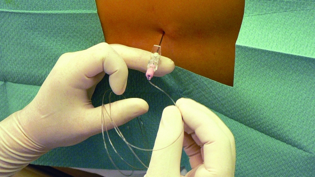 Epidurální analgezie - obrázek