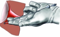Paracervikální analgezie - obrázek