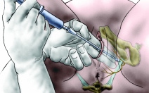 Pudendální analgezie - obrázek